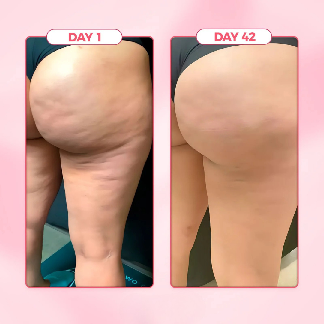 Cellulite Relief